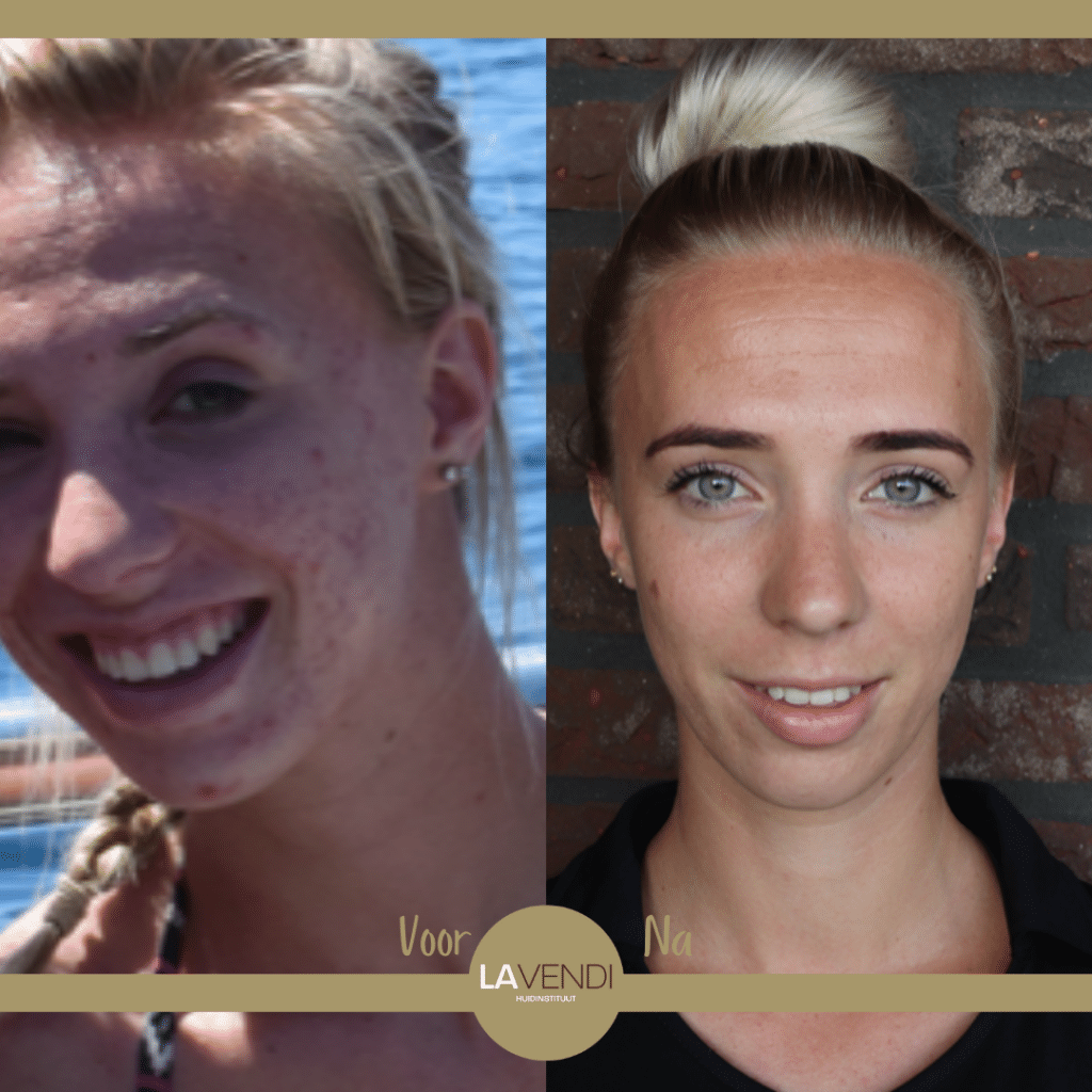 acne-behandeling